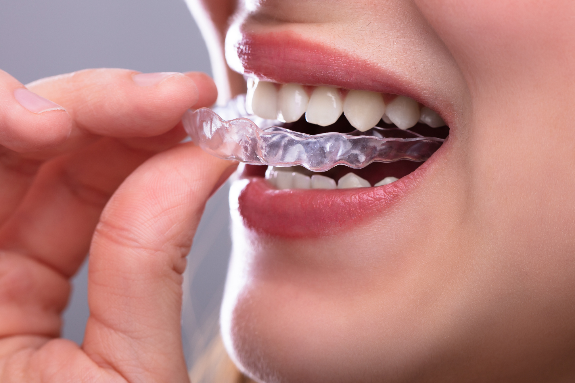 Invisalign Braces Before and After: Overbite, Crowding Teeth: Cost, Pain,  Tips 3M Clear Aligners 