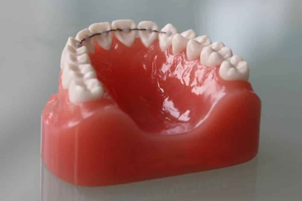 Clear Retainers